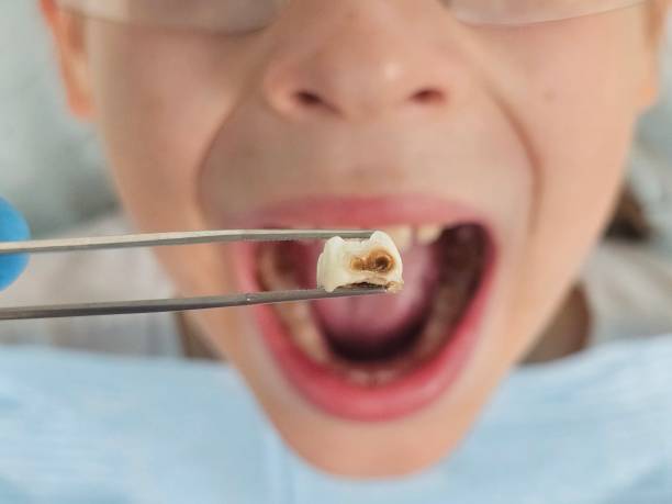 Best Broken or Cracked Tooth Emergency Dentist in Southwest Ranches, FL